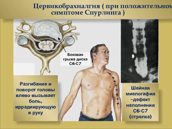 Цервикобрахиалгия ( при положительном симптоме Спурлинга ) Боковая грыжа диска С6-С7