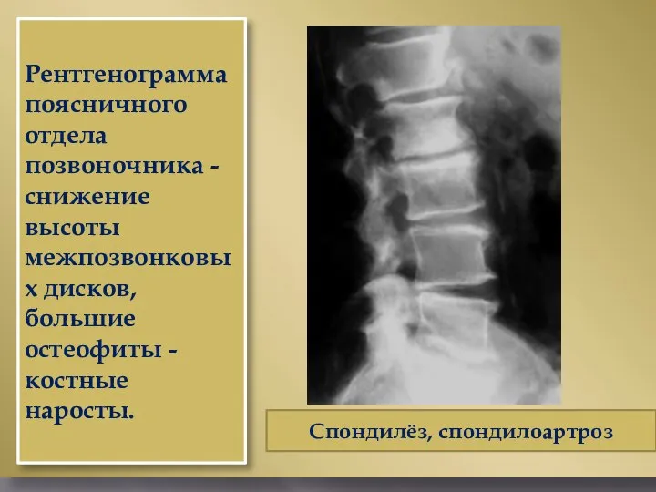 Рентгенограмма поясничного отдела позвоночника - снижение высоты межпозвонковых дисков, большие остеофиты - костные наросты. Спондилёз, спондилоартроз