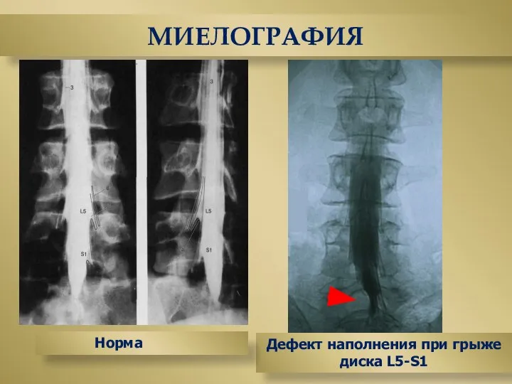 МИЕЛОГРАФИЯ Дефект наполнения при грыже диска L5-S1 Норма