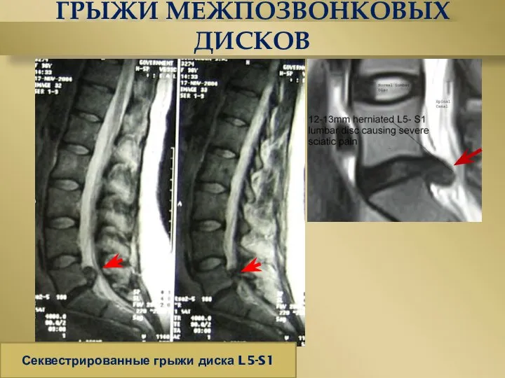 ГРЫЖИ МЕЖПОЗВОНКОВЫХ ДИСКОВ Секвестрированные грыжи диска L5-S1