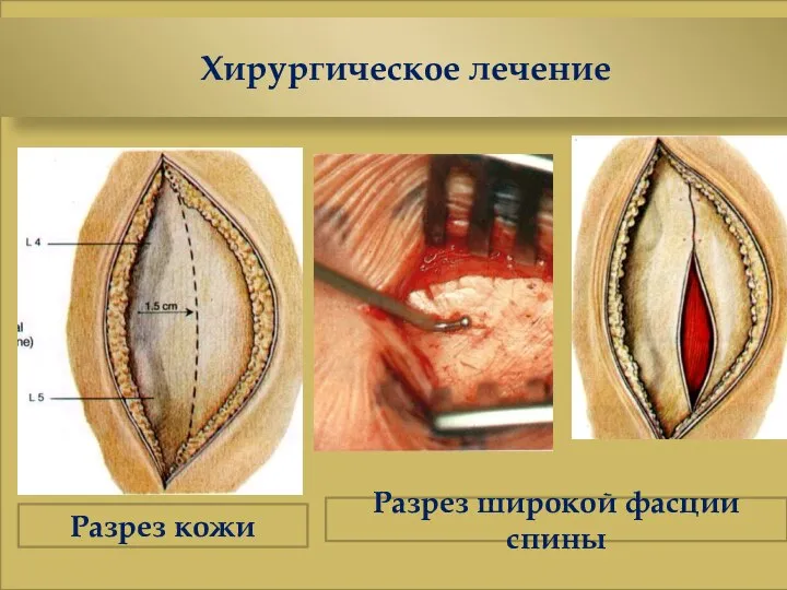 Хирургическое лечение Разрез кожи Разрез широкой фасции спины
