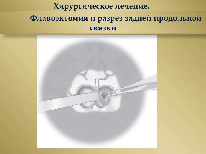 Хирургическое лечение. Флавоэктомия и разрез задней продольной связки