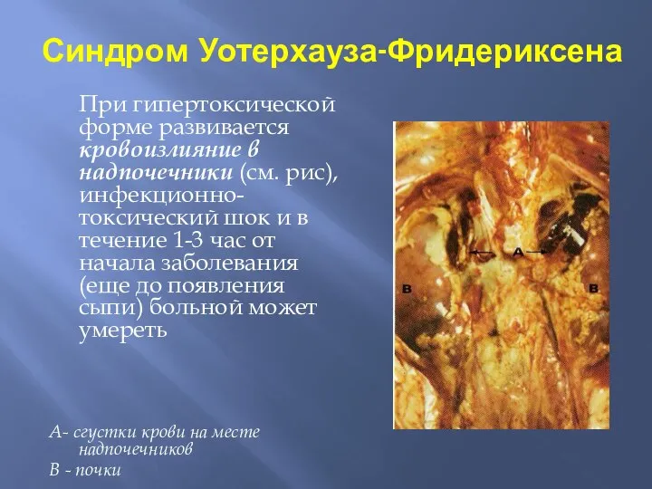 Синдром Уотерхауза-Фридериксена При гипертоксической форме развивается кровоизлияние в надпочечники (см. рис),