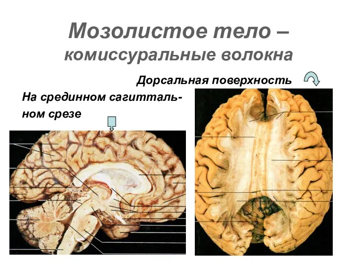 Мозолистое тело – комиссуральные волокна Дорсальная поверхность На срединном сагитталь- ном срезе