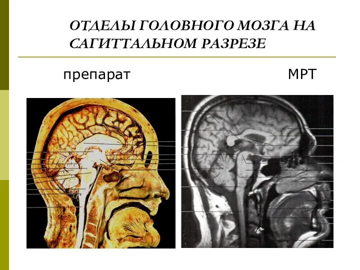 ОТДЕЛЫ ГОЛОВНОГО МОЗГА НА САГИТТАЛЬНОМ РАЗРЕЗЕ препарат МРТ