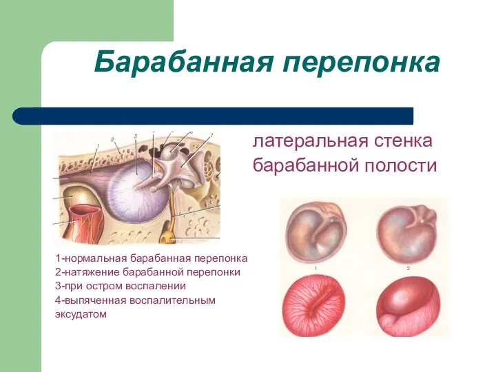 Барабанная перепонка латеральная стенка барабанной полости 1-нормальная барабанная перепонка 2-натяжение барабанной