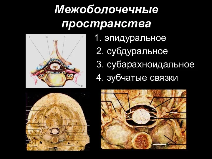 Межоболочечные пространства 1. эпидуральное 2. субдуральное 3. субарахноидальное 4. зубчатые связки