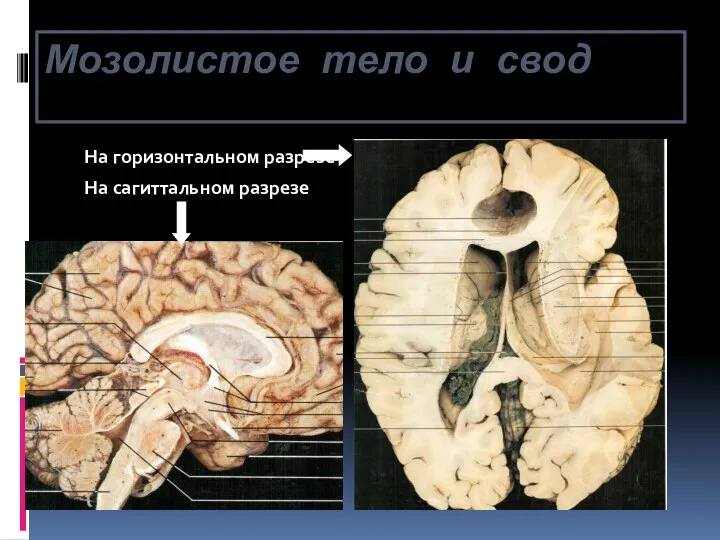Мозолистое тело и свод На горизонтальном разрезе На сагиттальном разрезе
