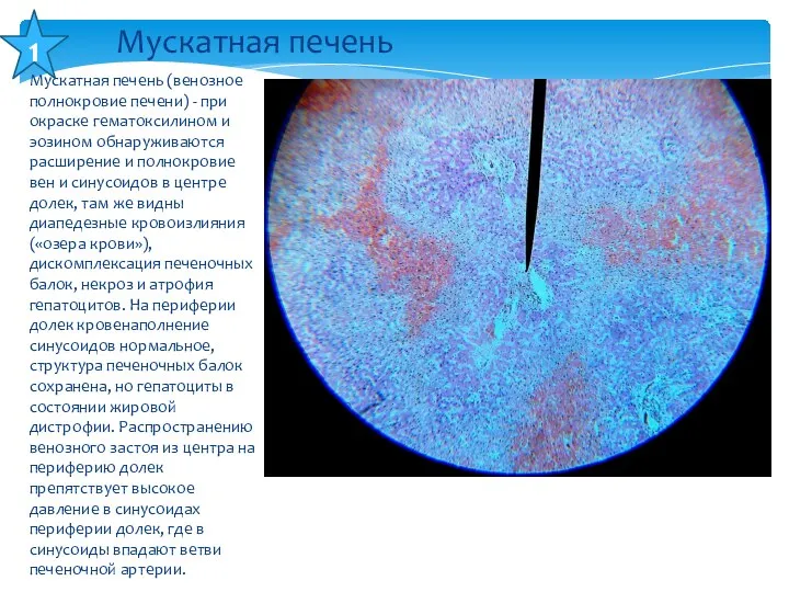 Мускатная печень (венозное полнокровие печени) - при окраске гематоксилином и эозином