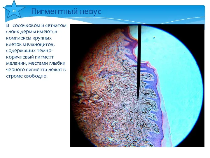 В сосочковом и сетчатом слоях дермы имеются комплексы крупных клеток меланоцитов,