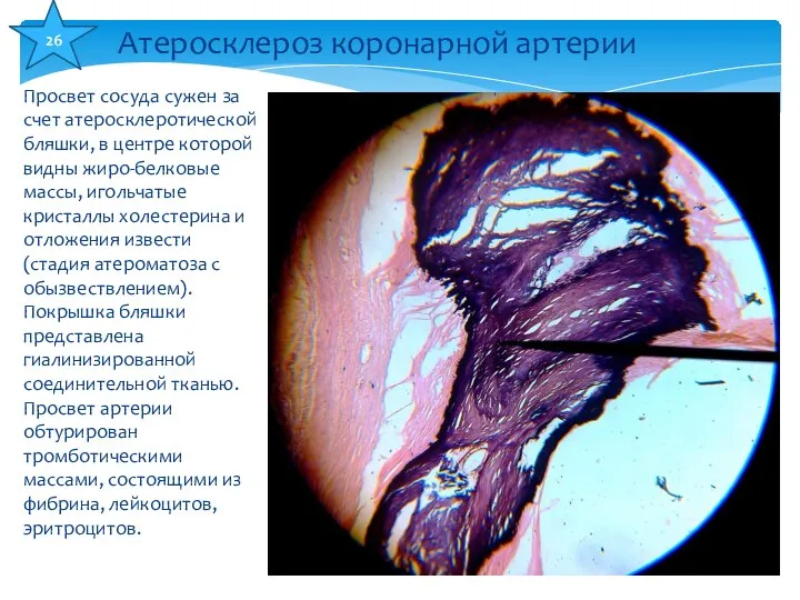 Просвет сосуда сужен за счет атеросклеротической бляшки, в центре которой видны