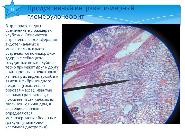 В препарате видны увеличенные в размерах клубочки. Отмечается выраженная пролиферация эндотелиальных