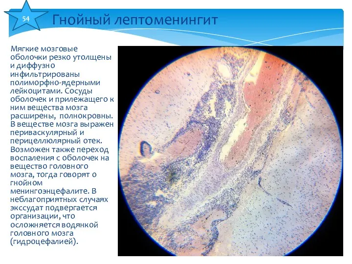 Мягкие мозговые оболочки резко утолщены и диффузно инфильтрированы полиморфно-ядерными лейкоцитами. Сосуды