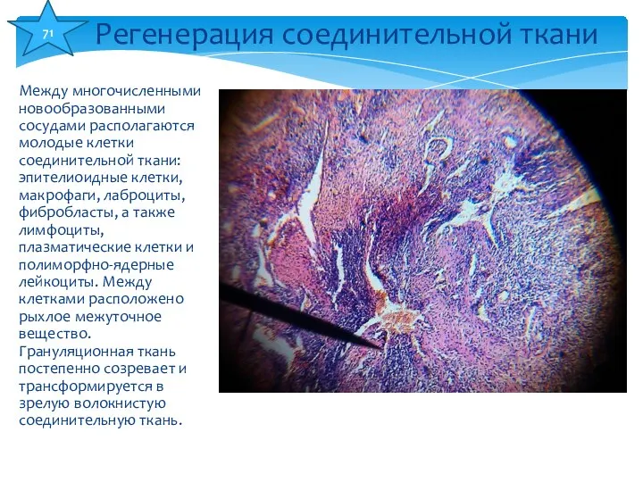 Между многочисленными новообразованными сосудами располагаются молодые клетки соединительной ткани: эпителиоидные клетки,