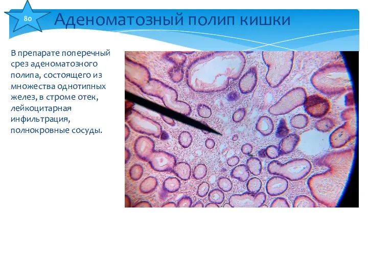 В препарате поперечный срез аденоматозного полипа, состоящего из множества однотипных желез,