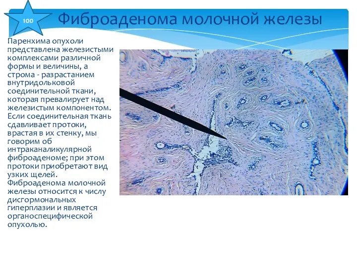 Паренхима опухоли представлена железистыми комплексами различной формы и величины, а строма