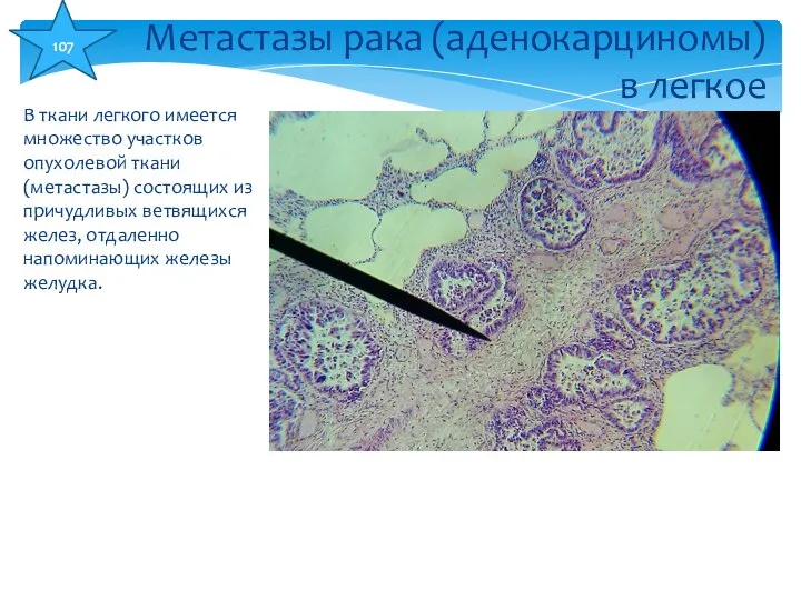В ткани легкого имеется множество участков опухолевой ткани (метастазы) состоящих из