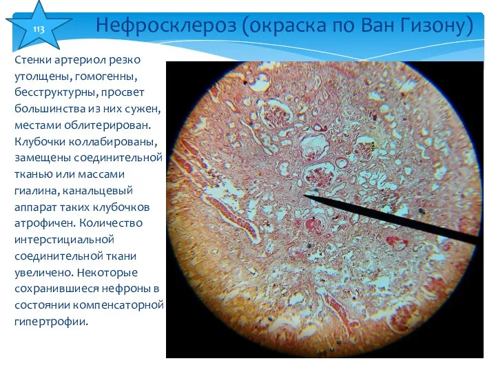 Стенки артериол резко утолщены, гомогенны, бесструктурны, просвет большинства из них сужен,