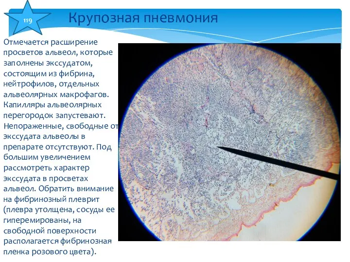 Отмечается расширение просветов альвеол, которые заполнены экссудатом, состоящим из фибрина, нейтрофилов,