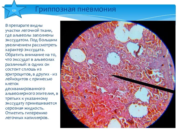 В препарате видны участки легочной ткани, где альвеолы заполнены экссудатом. Под