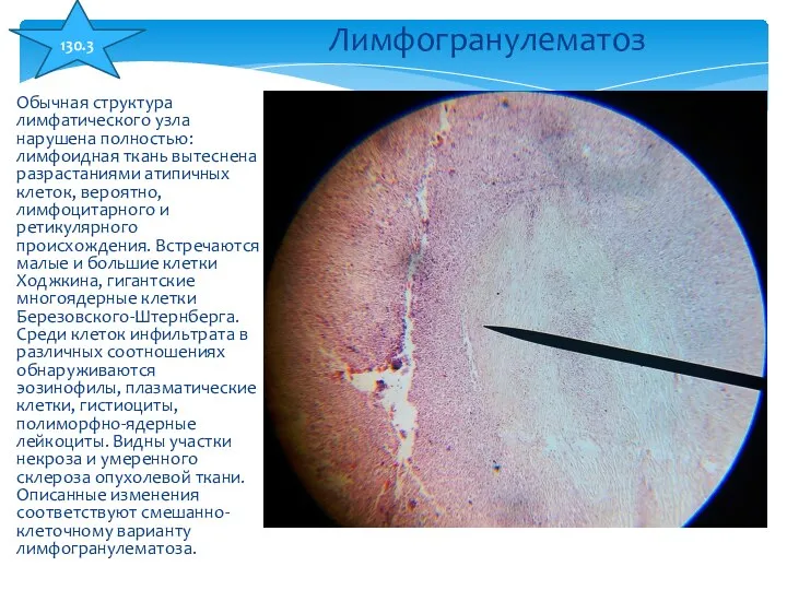 Обычная структура лимфатического узла нарушена полностью: лимфоидная ткань вытеснена разрастаниями атипичных