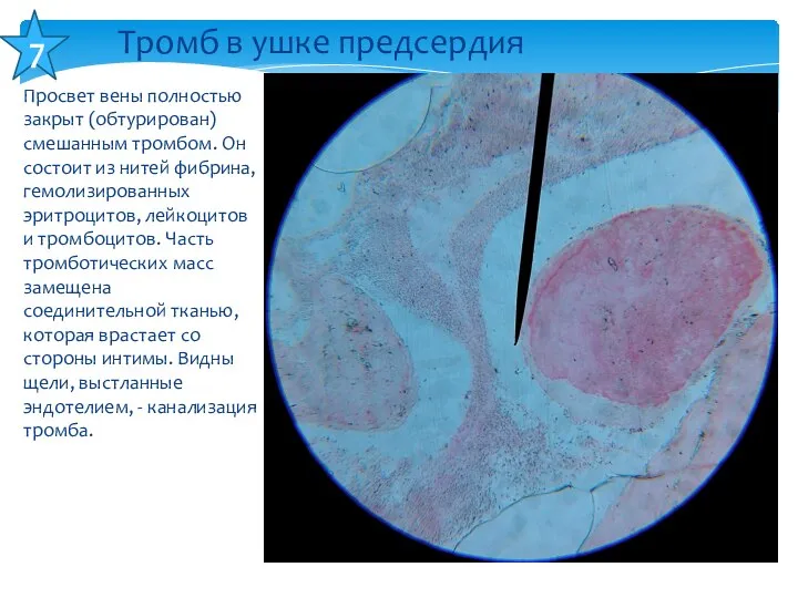 Просвет вены полностью закрыт (обтурирован) смешанным тромбом. Он состоит из нитей