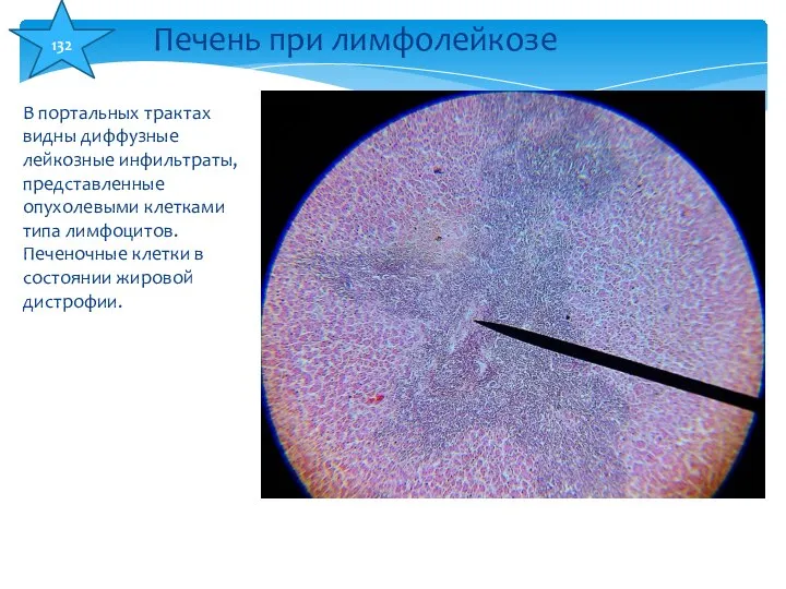 В портальных трактах видны диффузные лейкозные инфильтраты, представленные опухолевыми клетками типа