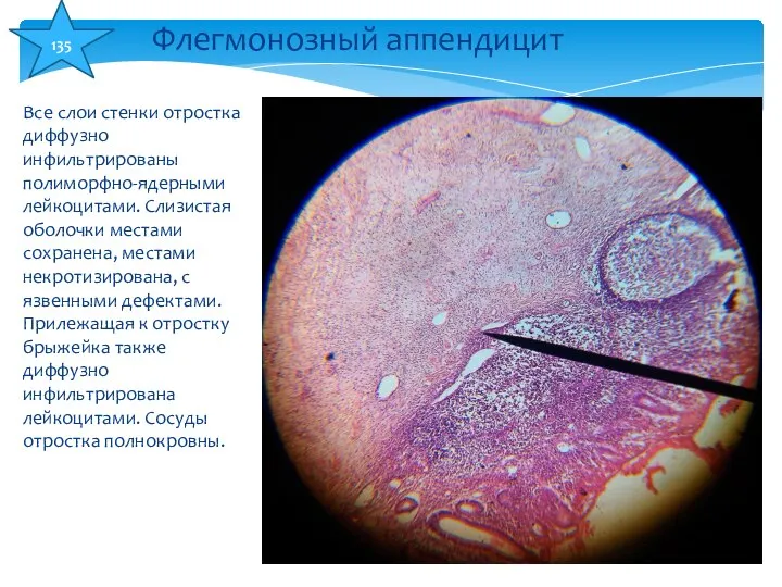 Все слои стенки отростка диффузно инфильтрированы полиморфно-ядерными лейкоцитами. Слизистая оболочки местами