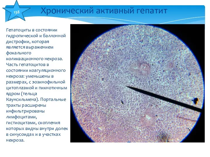 Гепатоциты в состоянии гидропической и баллонной дистрофии, которая является выражением фокального