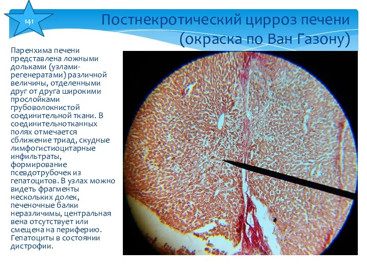 Паренхима печени представлена ложными дольками (узлами-регенератами) различной величины, отделенными друг от