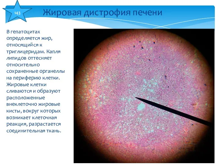 В гепатоцитах определяется жир, относящийся к триглицеридам. Капля липидов оттесняет относительно