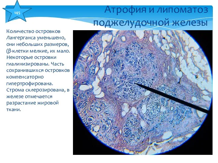 Количество островков Лангерганса уменьшено, они небольших размеров, (β-клетки мелкие, их мало.