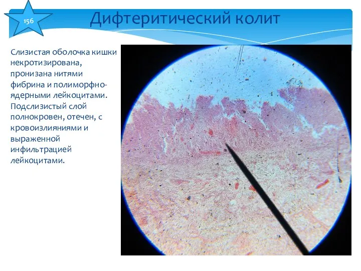 Слизистая оболочка кишки некротизирована, пронизана нитями фибрина и полиморфно-ядерными лейкоцитами. Подслизистый