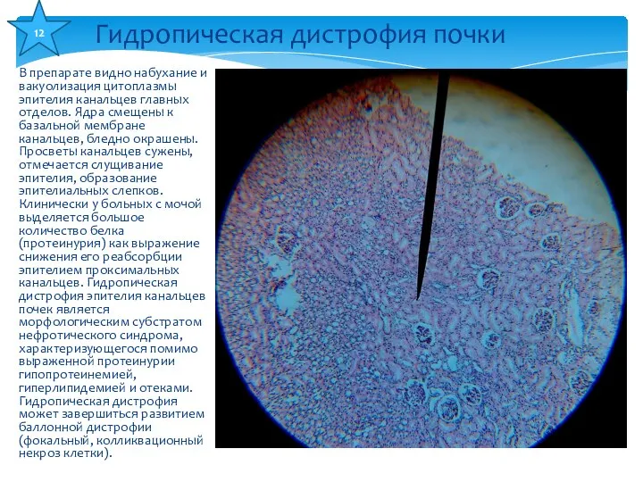 В препарате видно набухание и вакуолизация цитоплазмы эпителия канальцев главных отделов.