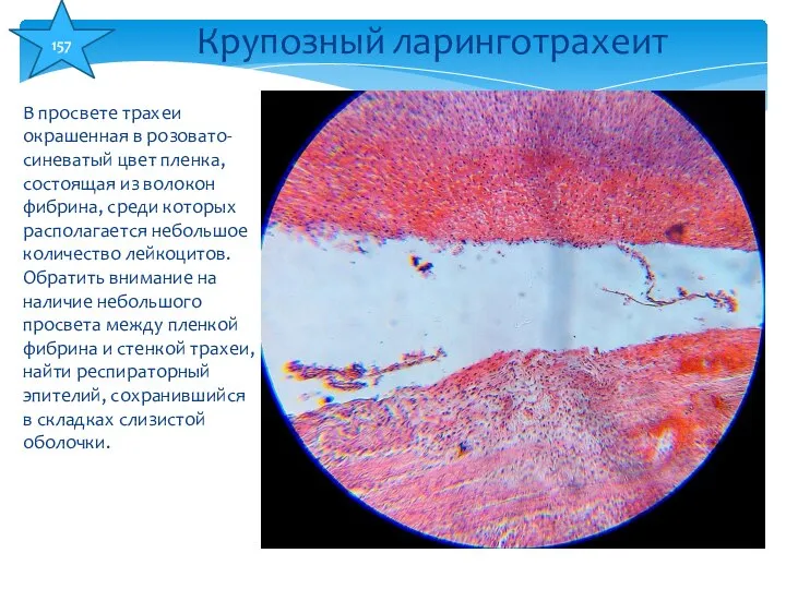 В просвете трахеи окрашенная в розовато-синеватый цвет пленка, состоящая из волокон