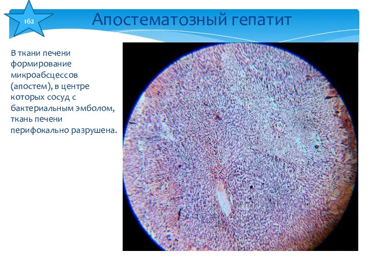 В ткани печени формирование микроабсцессов (апостем), в центре которых сосуд с