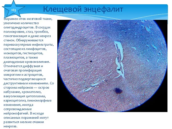 Выражен отек мозговой ткани, увеличено количество олигодендроцитов. В сосудах полнокровие, стаз,