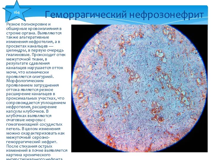 Резкое полнокровие и обширные кровоизлияния в строме органа. Выявляются также альтеративные