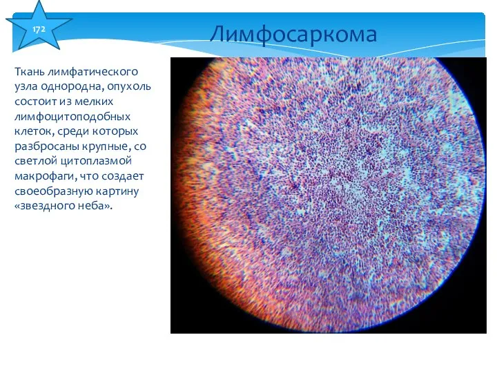 Ткань лимфатического узла однородна, опухоль состоит из мелких лимфоцитоподобных клеток, среди