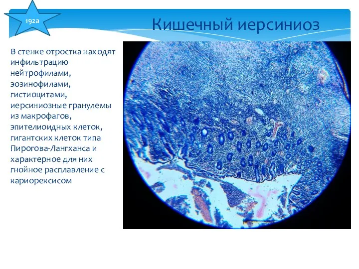 В стенке отростка находят инфильтрацию нейтрофилами, эозинофилами, гистиоцитами, иерсиниозные гранулемы из