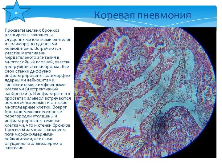 Просветы мелких бронхов расширены, заполнены слущенными клетками эпителия и полиморфно-ядерными лейкоцитами.