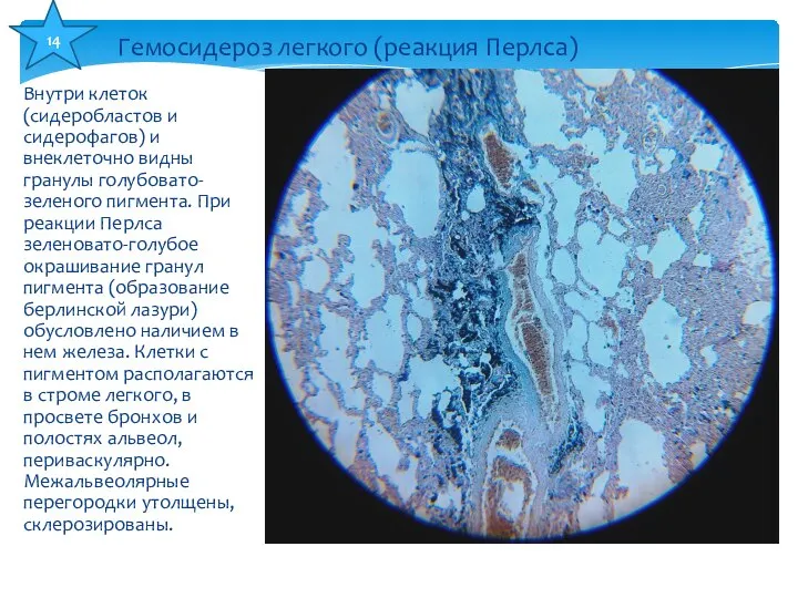 Внутри клеток (сидеробластов и сидерофагов) и внеклеточно видны гранулы голубовато-зеленого пигмента.