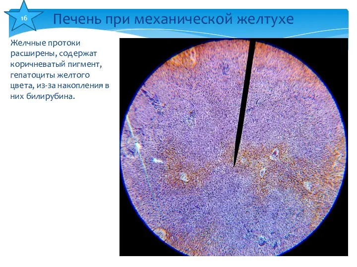 Желчные протоки расширены, содержат коричневатый пигмент, гепатоциты желтого цвета, из-за накопления