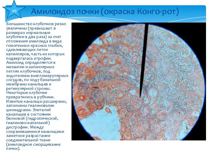 Большинство клубочков резко увеличены (превышают в размерах нормальные клубочки в два