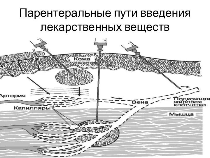 Парентеральные пути введения лекарственных веществ