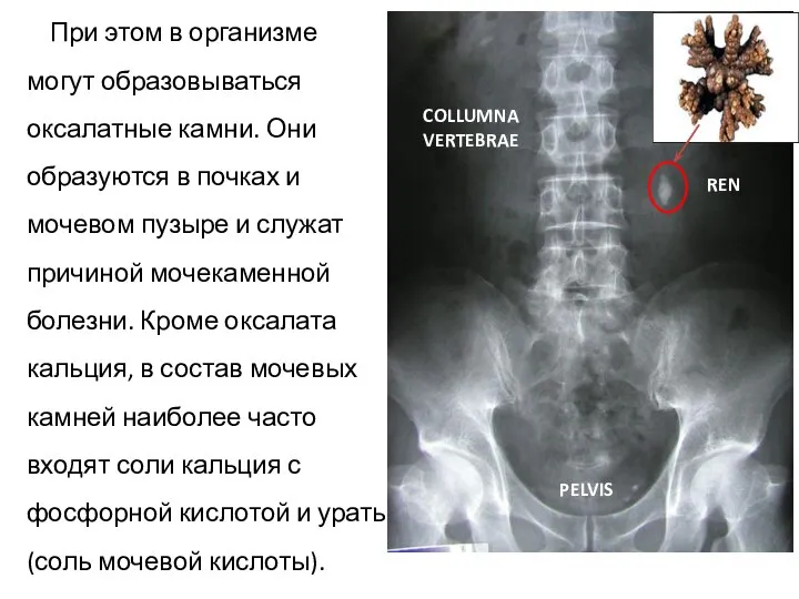 При этом в организме могут образовываться оксалатные камни. Они образуются в