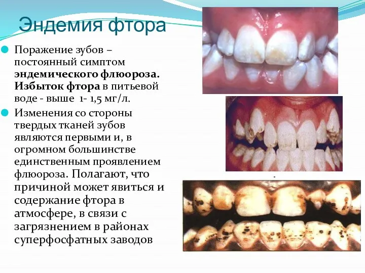 Эндемия фтора Поражение зубов – постоянный симптом эндемического флюороза. Избыток фтора