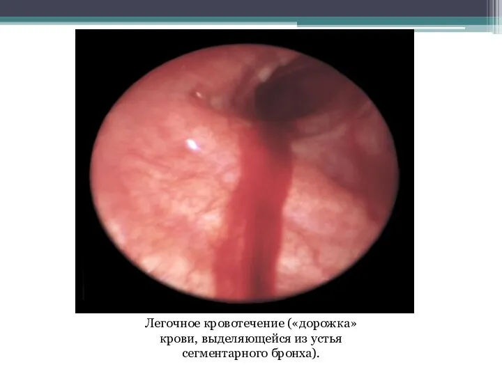 Легочное кровотечение («дорожка» крови, выделяющейся из устья сегментарного бронха).