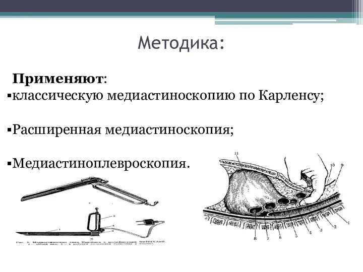 Методика: Применяют: классическую медиастиноскопию по Карленсу; Расширенная медиастиноскопия; Медиастиноплевроскопия.