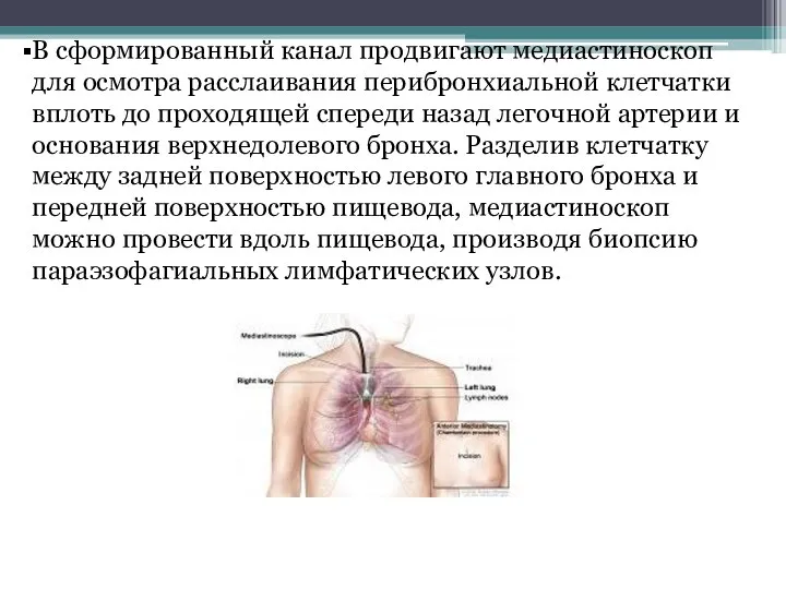 В сформированный канал продвигают медиастиноскоп для осмотра расслаивания перибронхиальной клетчатки вплоть